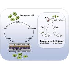 Once we have faced cancer, life does indeed take on new meaning. Sox2 Promotes Brain Metastasis Of Breast Cancer By Upregulating The Expression Of Fscn1 And Hbegf Molecular Therapy Oncolytics