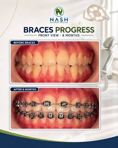 Eight month braces progress by Klinik Pergigian Nash