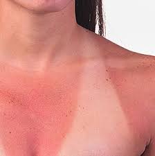 Home Remedies For Sunburn Peeling Skin Sunburn Remedies Home Remedies For Sunburn