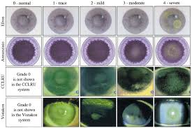 Validation Of Grading Scales For Contact Lens Complications