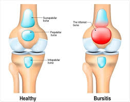 You can see it enclosing the glenohumeral joint and you can see its attachment on the anatomical neck of the this is the subtendinous bursa of the subscapularis. Bursitis And Osteoarthritis Similarities And Differences