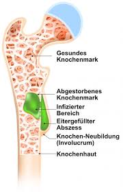 Image result for Osteomyelitis