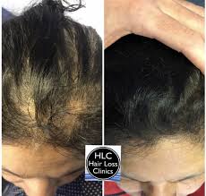 The best hair loss treatments for every budget. Hair Loss Specialist Clinic Hair Loss Specialist Clinic