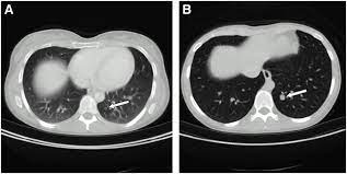 I freaking out today though because i have a hard area in my left breast. Can Pet Ct Replace Separate Diagnostic Ct For Cancer Imaging Optimizing Ct Protocols For Imaging Cancers Of The Chest And Abdomen Journal Of Nuclear Medicine