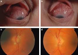 Image result for Scleritis