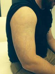 Tattoos in newport news on superpages.com. Laser Tattoo Removal Richmond Mechanicsville Va