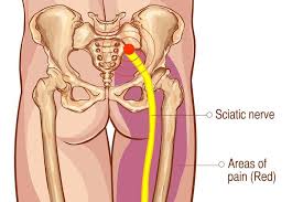 The thigh is located between the hip and the knee. Sciatica Lower Back Pain Chiropractor San Diego Ca
