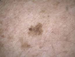 Image result for Solar Lentigo