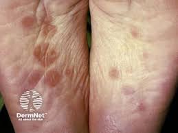 Image result for syphilis symptoms