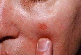 Skin cancer is one of the most common types of cancer. Skin Cancer Nashua Basal Cell Carcinoma New Hampshire Actinic Keratoses