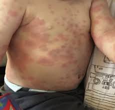 Management of Pediatric Urticaria with Review of the Literature