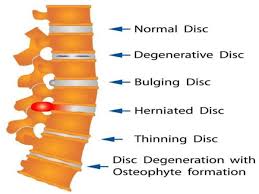 Tanda ini juga bisa digunakan sebagai rujukan ke data pada lokasi lain. Derita Angkara Slipped Disc