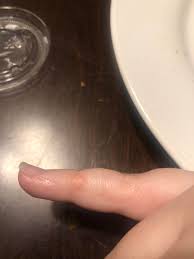 Check spelling or type a new query. Is This A Rheumatoid Nodule Rheumatoid