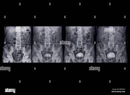 Image result for Intravenous Pyelogram