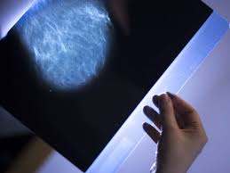 When malignant cancer cells form and grow within a person's breast tissue, breast cancer occurs. Stage 2 Breast Cancer Definition Treatment Outlook And More