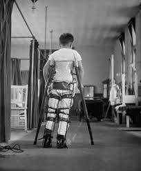 Image result for Polio