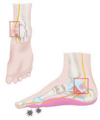 Tarsal Tunnel Syndrome Spine Specialist Vail Aspen Denver Co