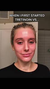 Stieva A Tretinoin Results