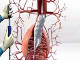 Endovascular Es