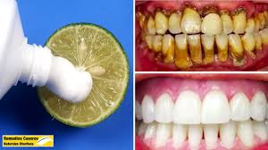 Si, la sal es capaz de ayudarte a recuperar el blanco de tus dientes, ya que repone los minerales perdidos en los mismos. En Solo 2 Minutos Blanquear Los Dientes Naturalmente Con Este Metodo Youtube