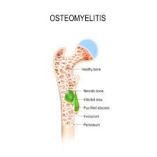 Image result for Osteomyelitis