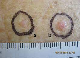 Racgp - Early Detection And Non-Invasive Diagnosis Of Basal Cell Carcinoma  Using A Dermatoscope