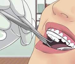 Check spelling or type a new query. Braces How To Articles From Wikihow