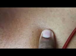 Spider nevus'u olan çoğu insan için tek belirsizlik, gemi kümesinin görünüşüdür. Spider Nevi Liver Cell Failure Youtube