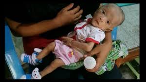 Ibu sila periksa mulut bayi kalau asyik menangis enggan menyusu bibir sumbing dan operasi pada celah langit mulut dan penyebabnya Video Kasihan Bayi Ini Nggak Punya Langit Langit Mulut Tribun Jateng