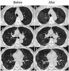 Image result for Inhalation Challenge Test