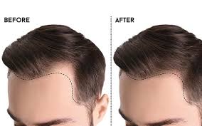 Hair may appear patchy with irregular bald areas. Understanding The Different Types Of Hairlines For Men And Women Skinkraft