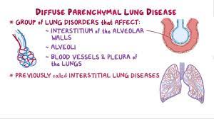 Early lung cancer detection with ct is based on finding noncalcified nodules (ncns) in the lung parenchyma that are thought to be the precursor to advanced lung cancers. Diffuse Parenchymal Lung Disease Clinical Practice Osmosis