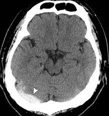Hyperattenuating Signs At Unenhanced Ct Indicating Acute Vascular Disease Radiographics
