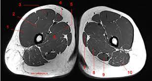 Thigh magnetic resonance imaging the thigh has some of the body's largest muscles. Mri Of The Thigh Detailed Anatomy Superior Part W Radiology