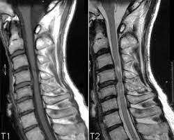 Cyst ， ependymoma やastrocytoma な ど の真性髄 内腫瘍 が挙 げ. æ—¥ã€…ã®ç—‡ä¾‹ 76 å¤–å‚·æ€§è„Šé«„ç©ºæ´žç—‡