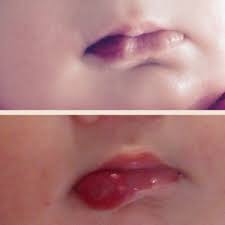 They tend to occur in older people (> 30 years of age), but do occur in children. Cherry Hemangioma Nbsp March 2015 Babies Forums What To Expect