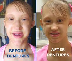 National Foundation for Ectodermal Dysplasias