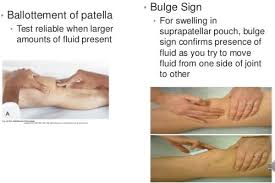 Image result for Ballottable Patella Sign