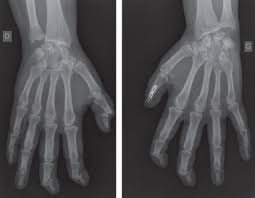 Manifestaciones Osteoarticulares De Las Histiocitosis Del Adulto Sciencedirect