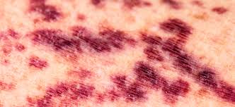 Image result for Vasculitis