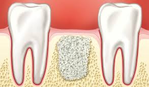 What Is Socket Preservation