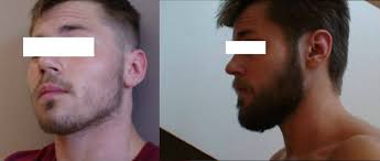 Leave the minoxidil on your face for 4 hours. Minoxidil For Beard Results Novocom Top