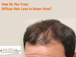Alopecia areata (an autoimmune condition that causes hair loss) telogen effluvium (temporary hair loss that's usually caused by stress or shock) How Do You Treat Diffuse Hair Loss In The Donor Area Hair Sure