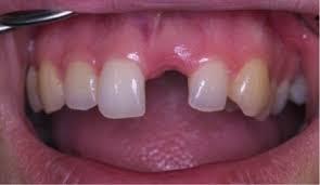 làm răng implant ở đâu tốt