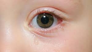 Tranenwegsstenose Tranende Augen Bei Kindern