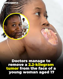 Grace, a 17-year-old Congolese girl, underwent an incredible  transformation. For a decade, she lived with a tumor the size of a football  that distorted her face and threatened her life. Thanks to