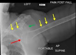 Image result for Shoulder XRay