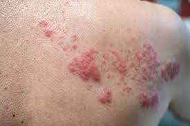 Shingles Symptoms Pictures Treatments And More