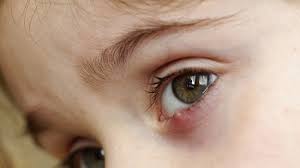 Ulciorul este o umflătură dureroasă, îmbibată cu puroi, de la nivelul pleoapelor. De Ce Apare Orjeletul Ulciorul La Ochi Èi Cum SÄ L Tratezi Cat Mai Rapid Mamaplus