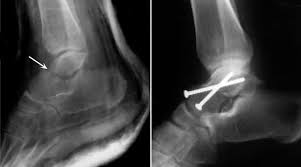 The talus is a bone in the foot and is part of the ankle joint. Talus Fractures Orthoinfo Aaos